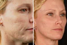 fractional laser skin treatment reviews
