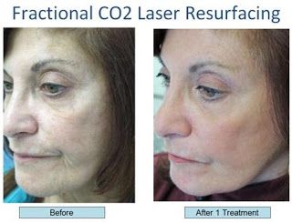 fractional laser skin treatment reviews