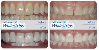 crest whitening strips review before and after