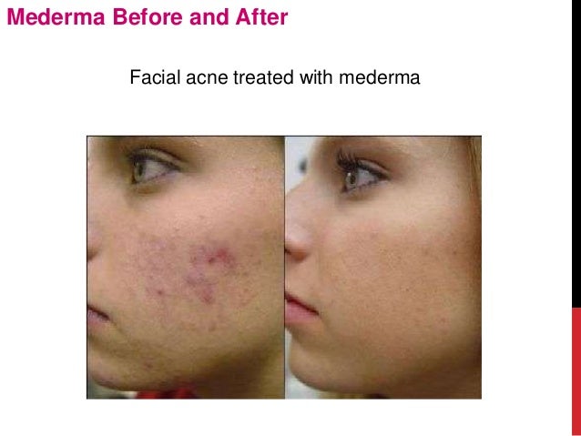 mederma reviews before and after